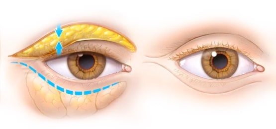 Blefaroplastia