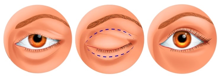 Ptosis palpebral