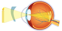 Cirugía Refractiva - General, Astigmatismo