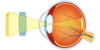 Cirurgia Refractiva - General, Hipermetropia