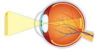 Cirurgia Refractiva - General, Normal